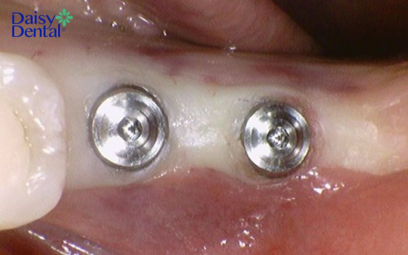 Implant Magicore