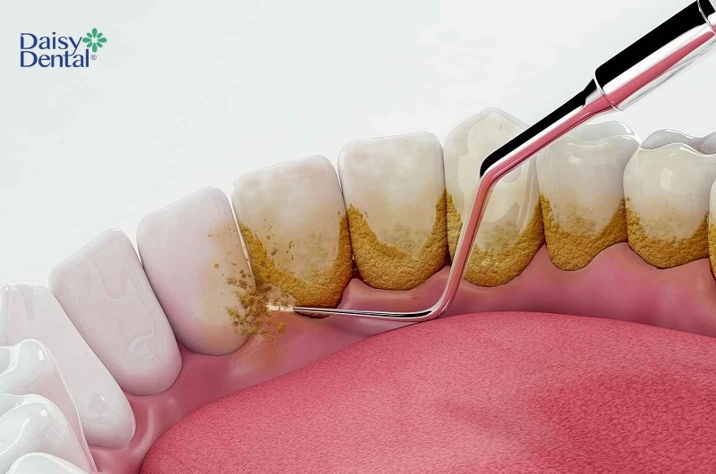 Lấy cao răng và vệ sinh răng miệng đúng cách có thể điều trị lợi mỏng và tụt ở tình trạng nhẹ