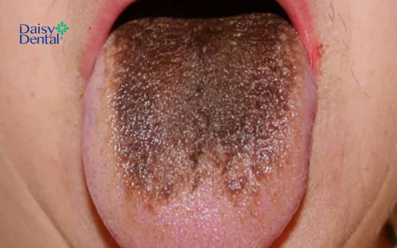 Nguyên nhân lưỡi bị đen thường là do các chất tạo màu trong rượu