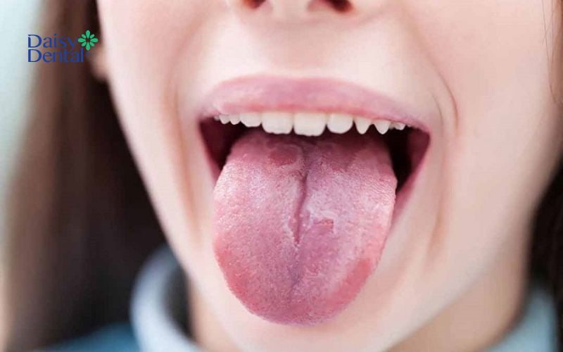 Bạn cần phân biệt tình trạng lưỡi đen và lưỡi tím để tránh nguy hiểm đến sức khỏe