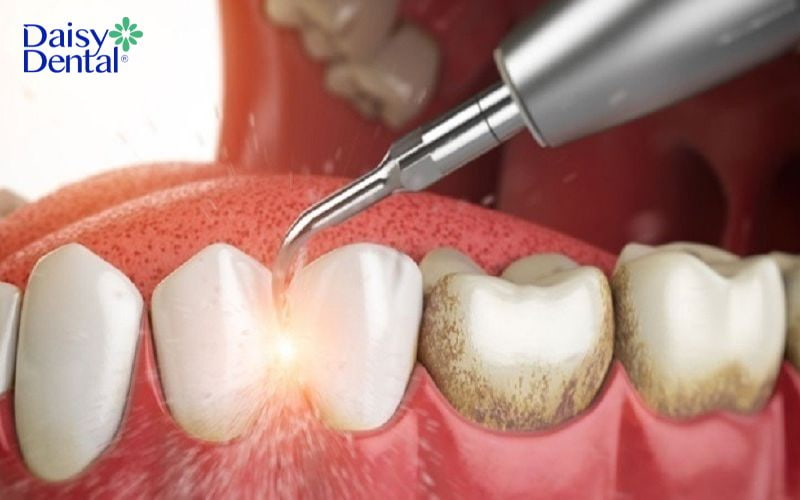 máy lấy cao răng tại nhà