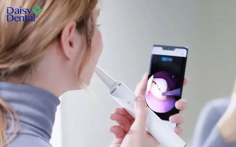 máy lấy cao răng tại nhà