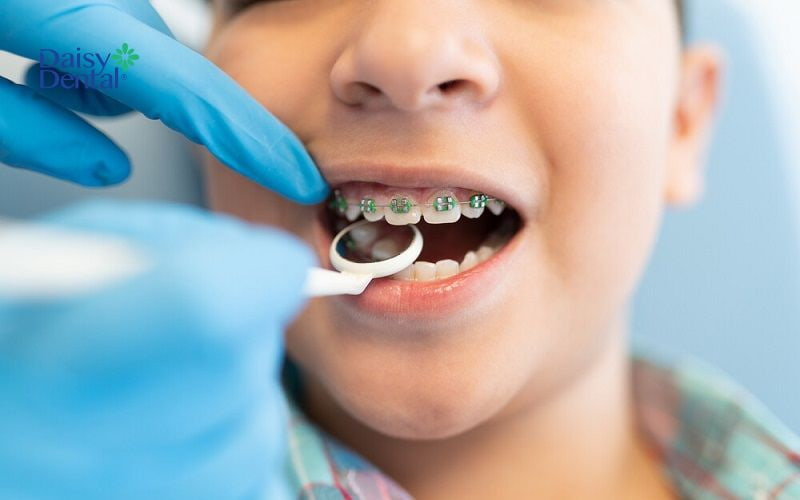 Trẻ em răng vẫn đang trong quá trình phát triển có thể không cần nhổ răng