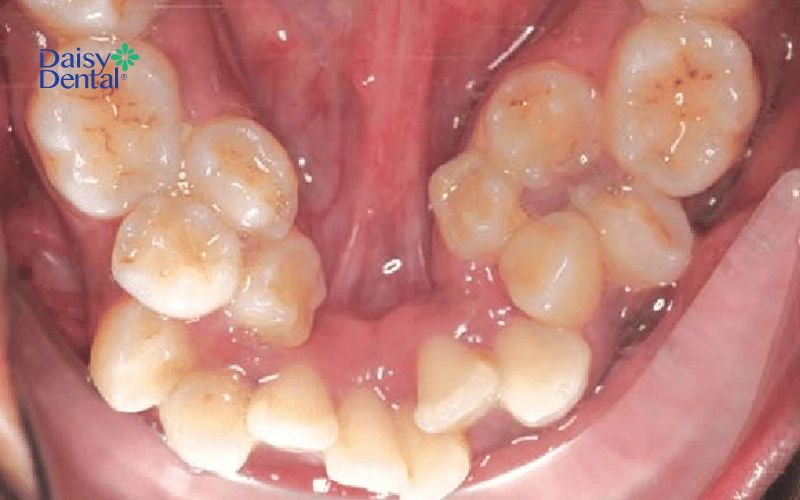 Trường hợp răng mọc nhiều trong cung hàm sẽ được bác sĩ nhổ răng khi niềng để đảm bảo mang lại hiệu quả chỉnh nha cao