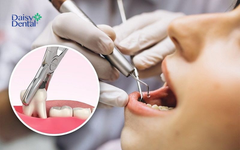 Răng số 8 được chỉ định nhổ bỏ khi niềng do mọc lệch, mọc ngầm gây đau nhức, ảnh hưởng đến các răng kế cạnh