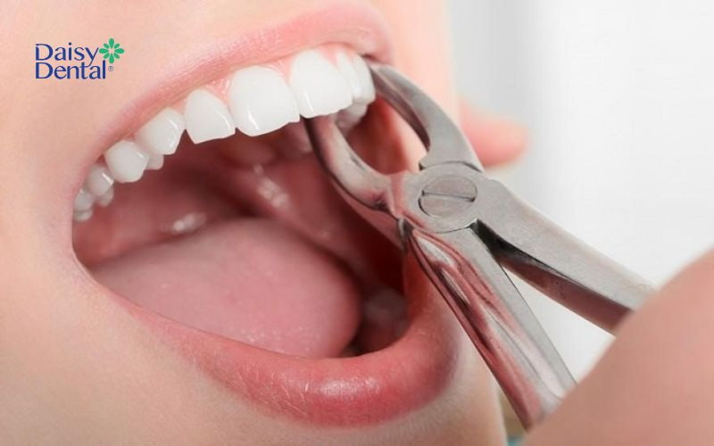 Nhổ răng thường được bác sĩ thăm khám, đánh giá, cân nhắc kỹ lưỡng, nhổ răng ít quan trọng nên không gây nguy hiểm và không gây ảnh hưởng đến sức khoẻ