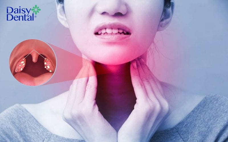 Nuốt nước bọt thấy vướng ở cổ họng