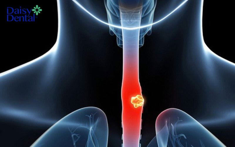 Nuốt nước bọt thấy vướng ở cổ họng