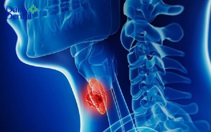 Nuốt nước bọt thấy vướng ở cổ họng