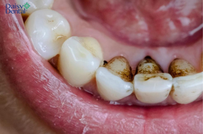 Cao răng tích tụ lâu ngày là nguyên nhân hàng đầu gây đen răng