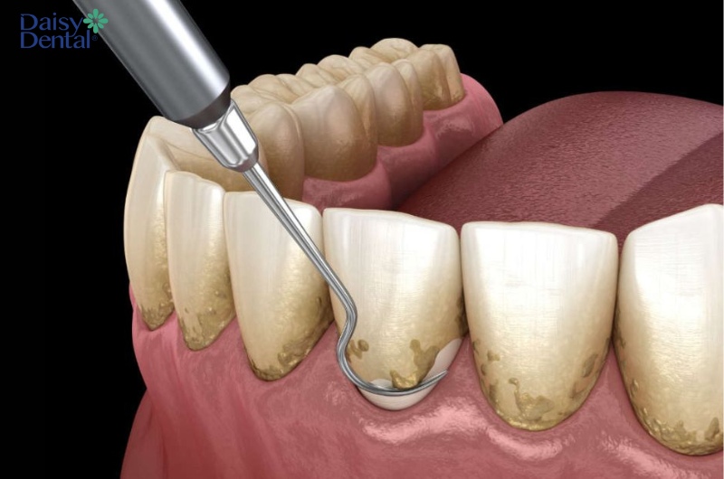 Bác sĩ có thể chỉ định cạo vôi răng để khắc phục tình trạng này