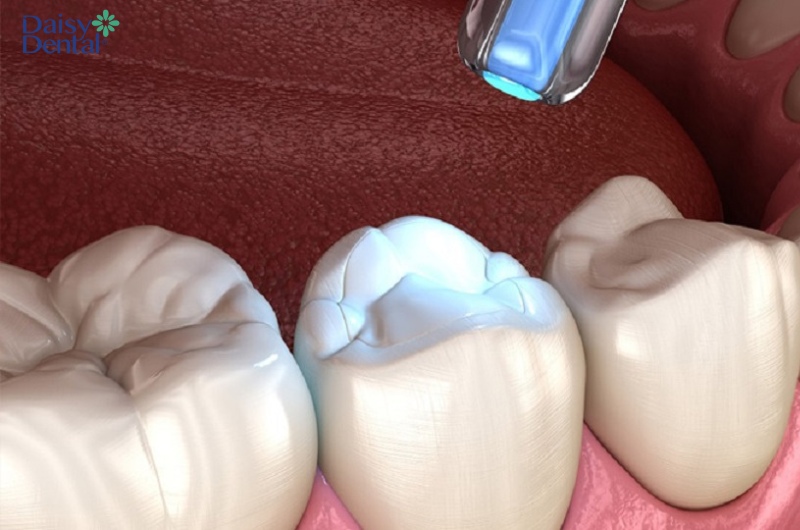 Nếu người bệnh bị sâu răng, bác sĩ sẽ tiến hành trám