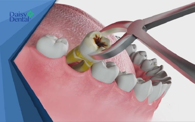 Sâu răng là bệnh lý thường gặp ở răng cấm