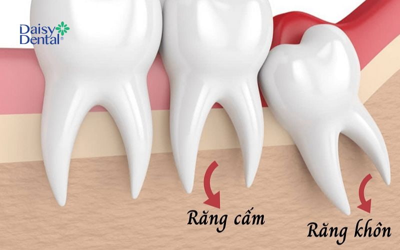 Răng khôn không phải là răng cấm