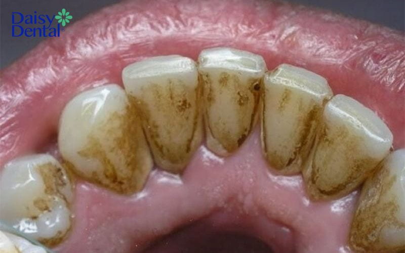 răng người có độc không