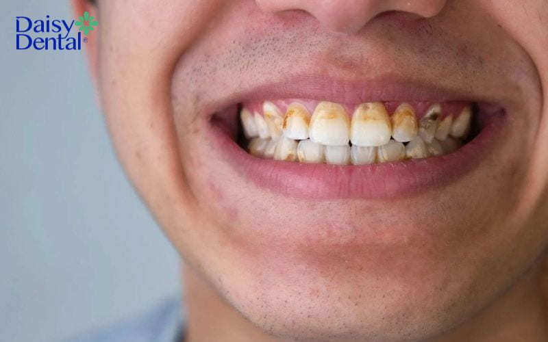 răng người có độc không