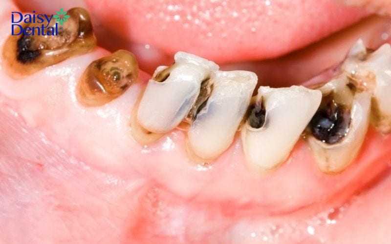 răng người có độc không