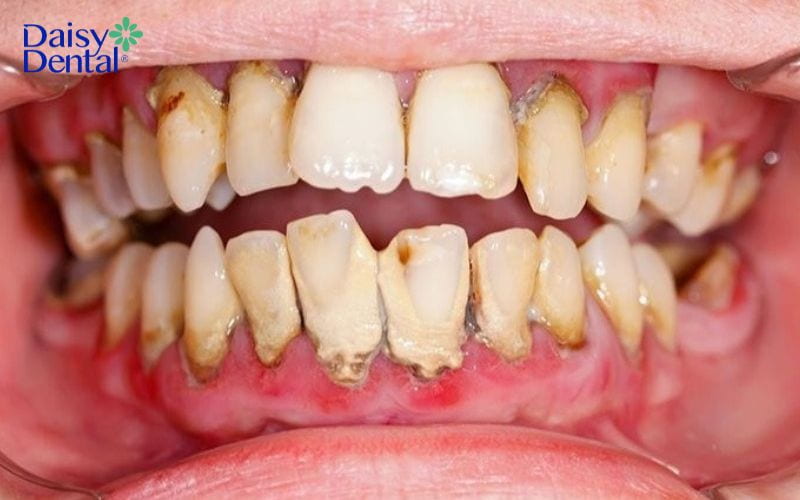 răng người có độc không