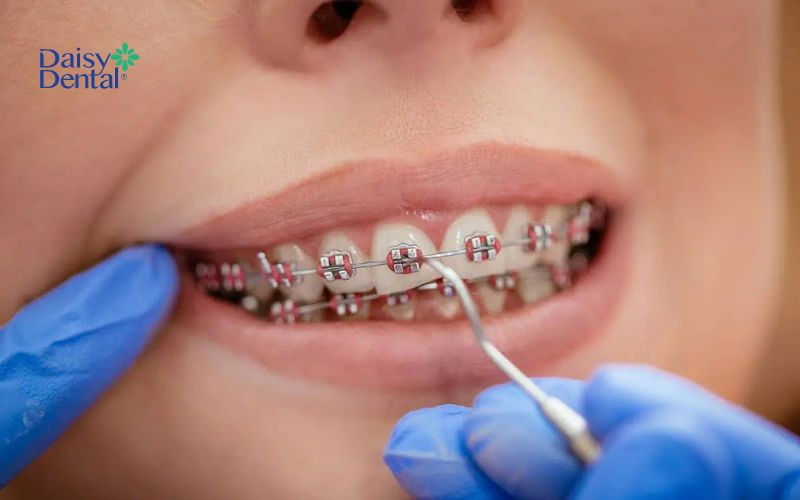Đây là giai đoạn cần thiết trong quá trình niềng răng