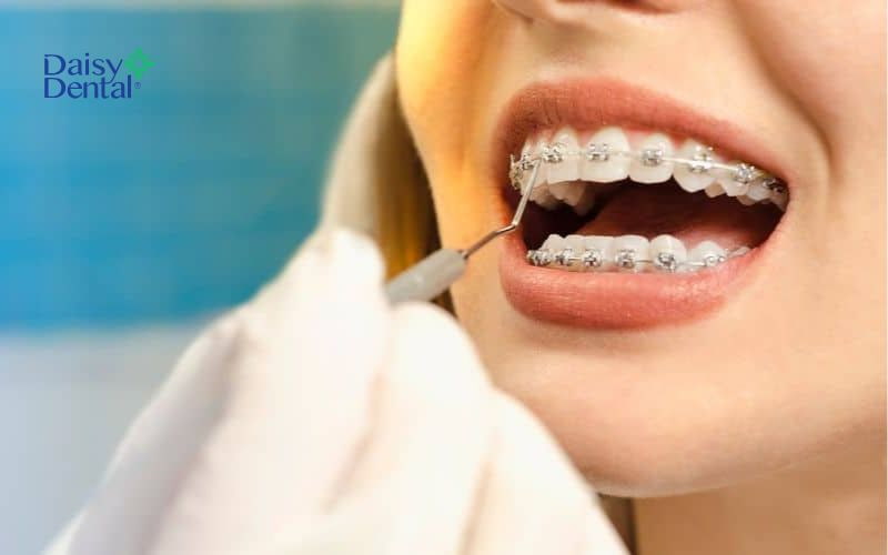 Tùy vào tình trạng răng và phương pháp chỉnh nha mà bác sĩ sẽ sắp xếp lịch siết răng phù hợp với mỗi người