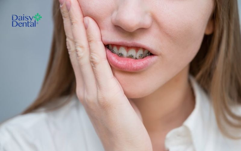 Sau khi siết răng, bạn sẽ thấy đau nhức trong khoảng từ 3 - 5 ngày
