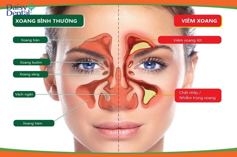 So sánh xoang mũi bình thường và khi bị viêm xoang