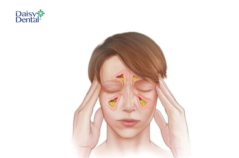 Nếu không điều trị kịp thời, viêm xoang có thể trở nặng, tăng nguy cơ nhiễm trùng não