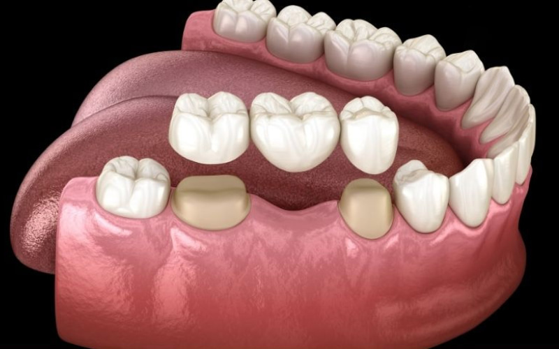 Cầu răng bao gồm các răng giả (pontic) được gắn liền với các mão răng (crown) ở hai đầu, chụp lên các răng thật bên cạnh khoảng trống (răng trụ).