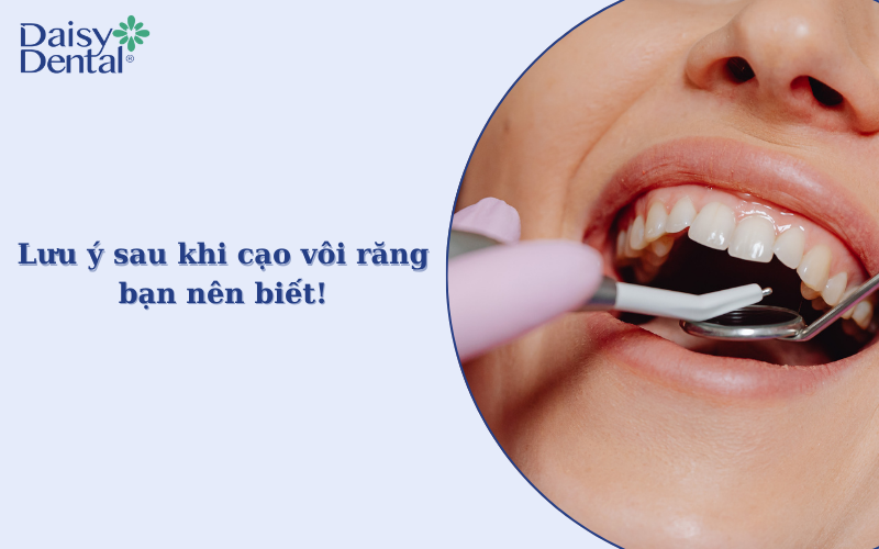 Cao vôi răng 10