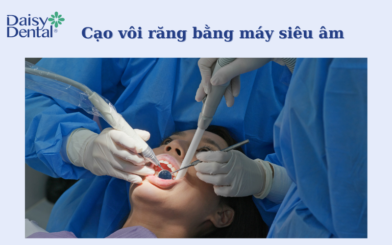 Cạo vôi răng bằng sóng siêu âm