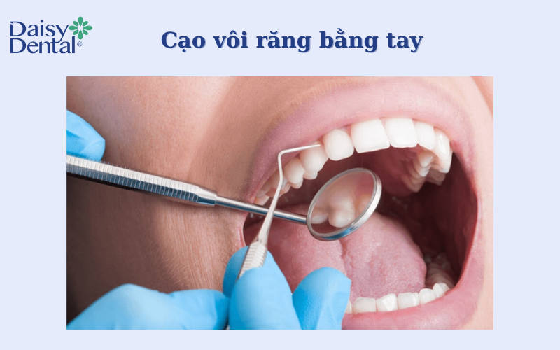 Cạo vôi răng bằng tay