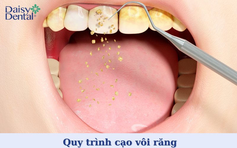 Cạo vôi răng 8