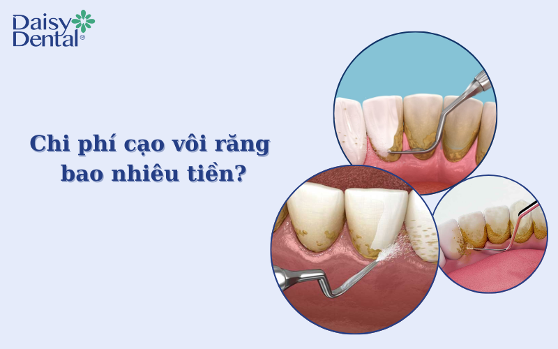 Cạo vôi răng