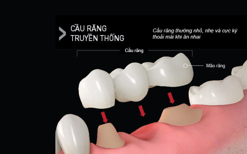Cầu răng thường nhỏ, nhẹ nên khá thoải mái khi ăn nhai