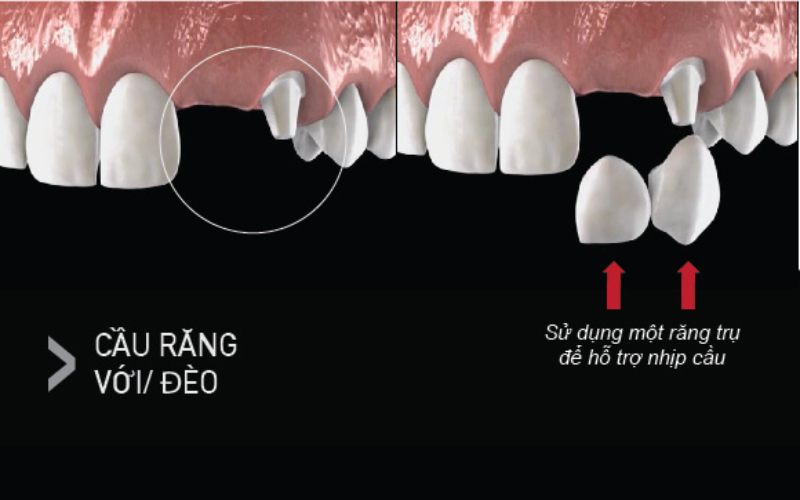 Cầu răng đèo không được khuyên dùng bởi hưởng đến các răng trụ nếu tính lực nhai không tốt.