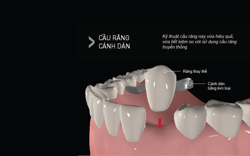 loại cầu răng này là nó ít xâm lấn hơn so với cầu răng truyền thống bởi không yêu cầu mài nhiều răng trụ.
