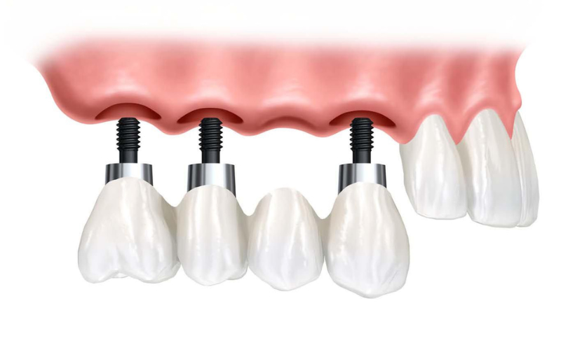 Trụ Implant đóng vai trò như chân răng thật, giúp cầu răng sứ vững chắc và chịu lực nhai tốt.