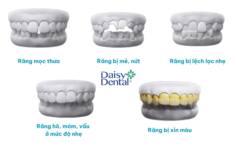 Các trường hợp nên dán sứ Veneer