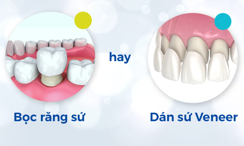 Việc lựa chọn phương pháp nào phù hợp sẽ phụ thuộc vào tình trạng răng miệng và nhu cầu thẩm mỹ của từng người. 