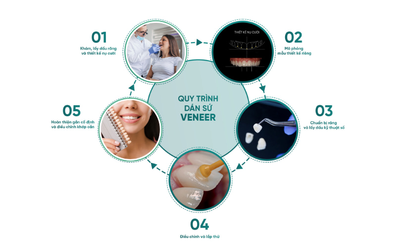 Quy trình dán sứ Veneer có thể khác nhau tùy thuộc vào tình trạng răng miệng của từng người và kỹ thuật của bác sĩ.