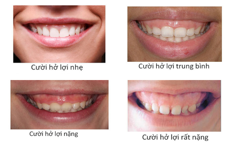 Tình trạng cười hở lợi có thể được phân loại dựa trên mức độ hở lợi và nguyên nhân gây ra.
