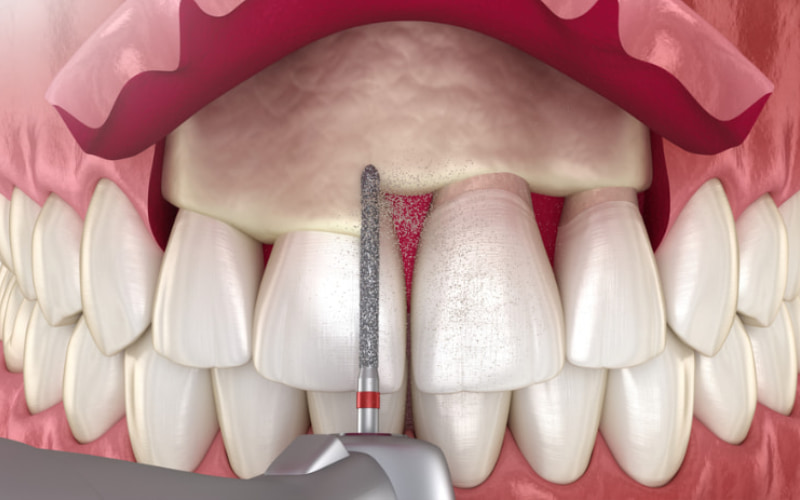 thủ thuật kéo dài thân răng thường được thực hiện kết hợp với cắt lợi để điều trị tình trạng cười hở lợi.