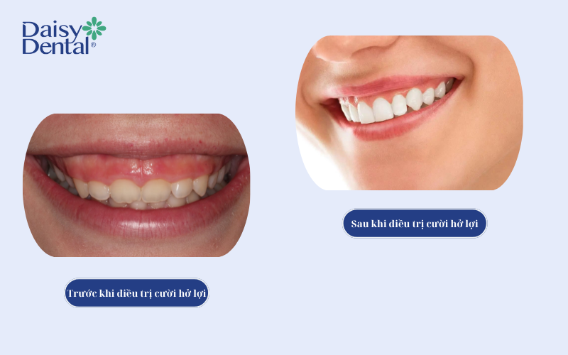 Điều trị cười hở lợi 7