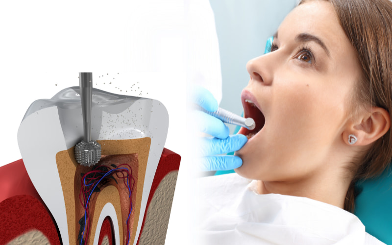 Việc lấy tủy răng cho trẻ em cần được thực hiện khi tủy răng bị tổn thương hoặc viêm nhiễm nặng