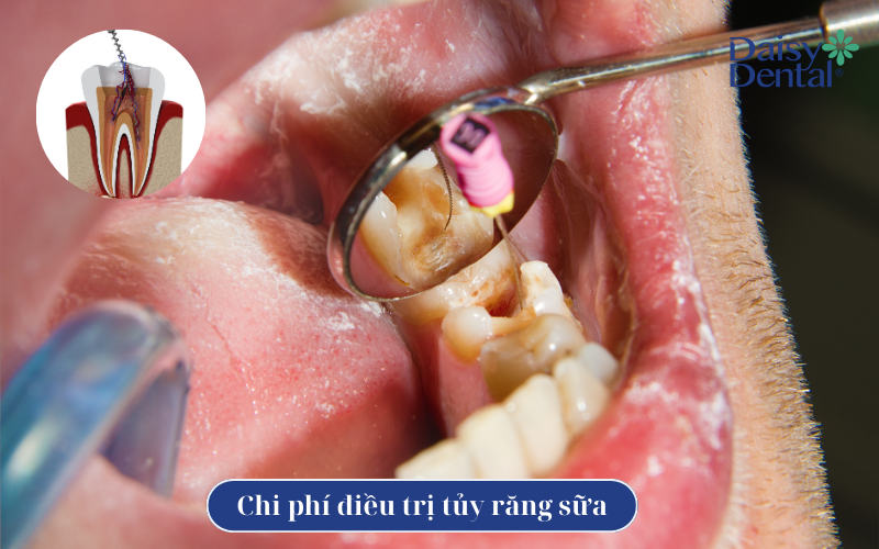 Điều trị tủy răng sữa 6