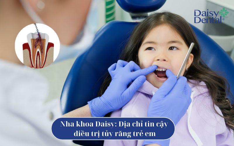 Điều trị tủy răng sữa 7