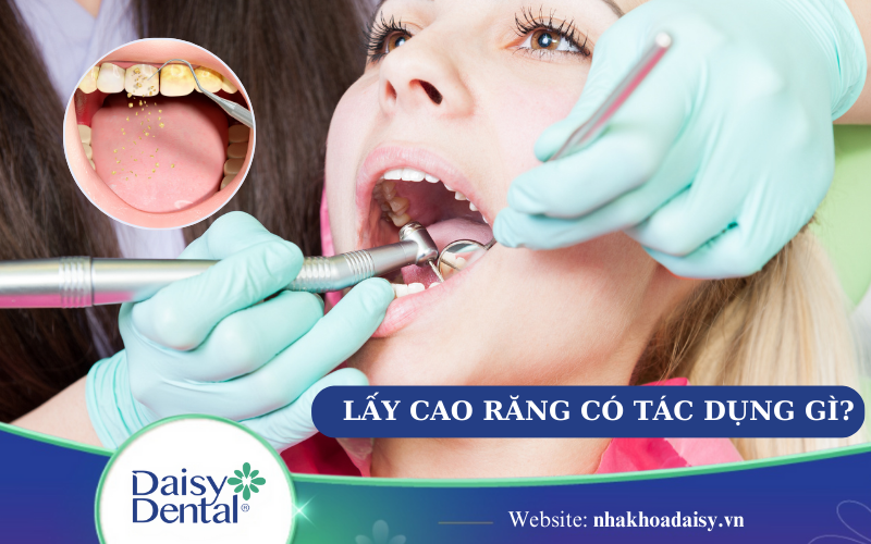 Lấy cao răng có tác dụng gì
