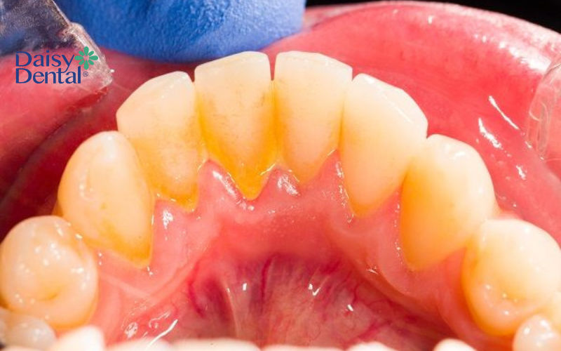 Lấy cao răng có tác dụng gì 2