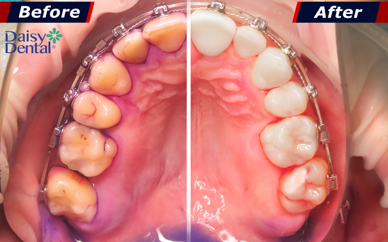Lấy cao răng có tác dụng gì 6