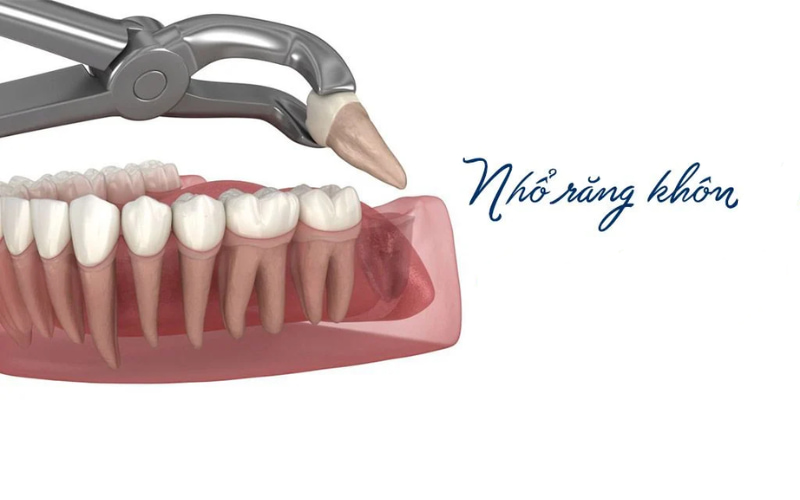 Nhổ răng khôn là một tiểu phẫu được thực hiện bởi bác sĩ nha khoa để loại bỏ một hoặc nhiều răng khôn (răng số 8).